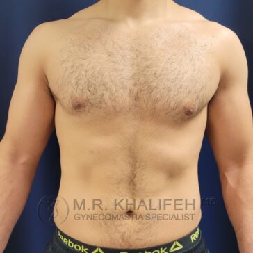 A shirtless man stands against a plain dark blue background, facing forward. Text at the bottom reads "M.R. Khalifeh MD, Gynecomastia Specialist.