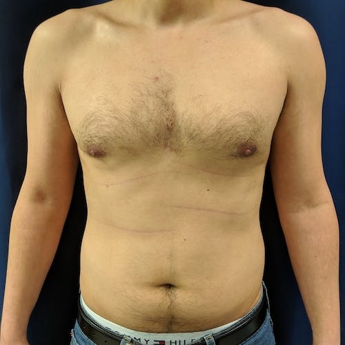 A shirtless person stands facing forward with a visible indentation in the center of the chest, blue jeans partially visible, against a dark background.