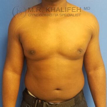 A man stands shirtless against a blue background, showing his chest and abdomen. The image is watermarked with a gynecomastia specialist's name and credentials.