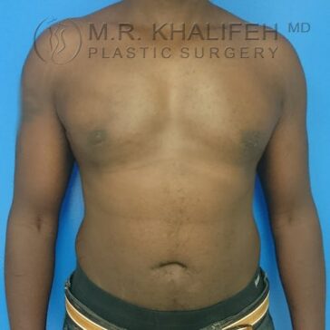 A man’s bare chest and abdomen are shown against a blue background, with “M.R. Khalifeh MD Plastic Surgery” watermarked at the top.