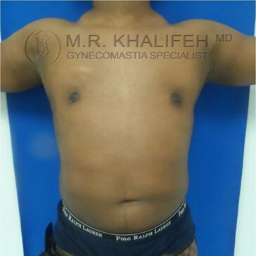 A person with visible gynecomastia stands against a blue background with arms raised; text reads "M.R. Khalifeh MD Gynecomastia Specialist.