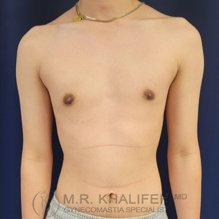 A shirtless person with a flat chest stands against a dark background, wearing a necklace. The watermark at the bottom reads "M.R. Khalifeh, MD Gynecomastia Specialist.