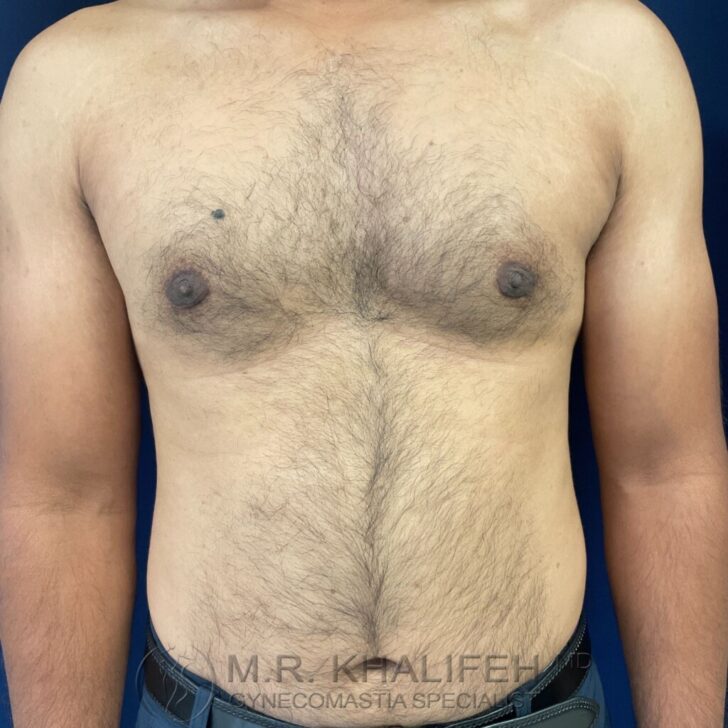 A shirtless adult male with visible chest and abdominal hair stands against a dark blue background, arms at sides. Text at the bottom reads "M.R. Khalifeh MD Gynecomastia Specialist.
