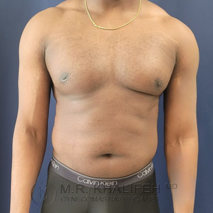 A shirtless person facing forward, wearing a gold necklace and black Calvin Klein underwear, standing against a plain dark background. Text on image mentions a gynecomastia specialist.