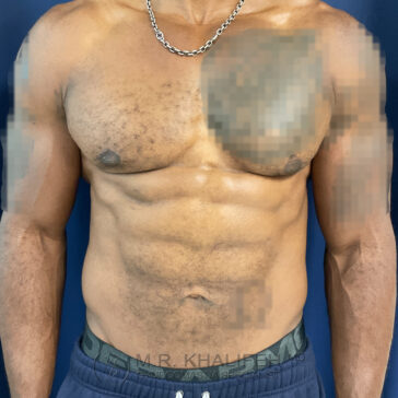 Shirtless man standing against a blue background, with portions of the chest area pixelated for privacy.