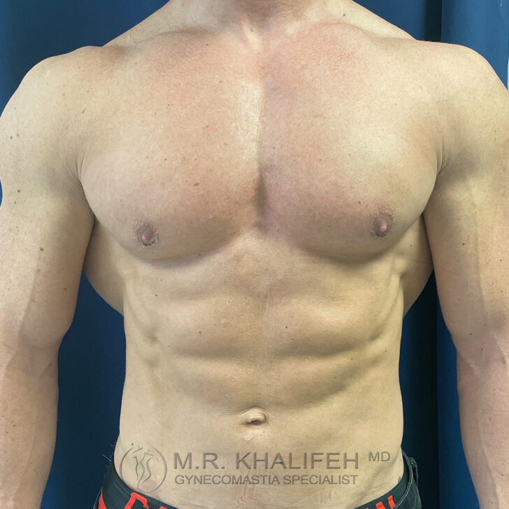 A shirtless male torso showing defined chest and abdominal muscles, with slight scarring under the nipples, on a blue background.