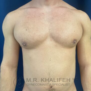 A shirtless person with visible enlargement of breast tissue. Text at the bottom reads "M.R. Khalifeh MD Gynecomastia Specialist." Blue background.