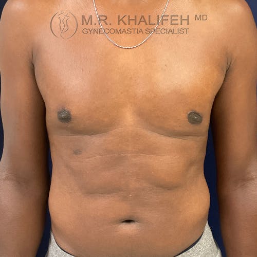 A shirtless person stands facing forward against a dark background, with a doctor's name and "gynecomastia specialist" watermark at the top of the image.