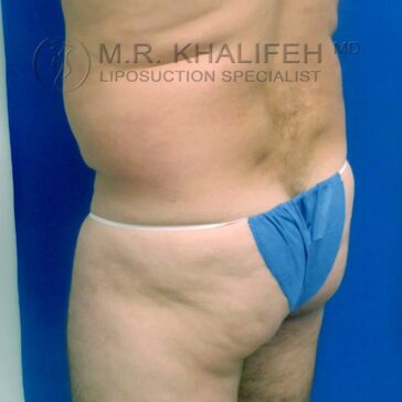 A person standing sideways wearing a blue disposable garment, displaying their lower back and hips, with a blue background. Text on image: "M.R. Khalifeh MD Liposuction Specialist.