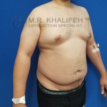 Shirtless person with medical bandages and IV on arm stands against a blue background, showing the torso and upper legs.