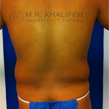 A person’s bare back is shown with slight fat deposits at the waist. The photo background is blue, and the individual is wearing a blue cloth at the waist. Text overlay includes a doctor's name.