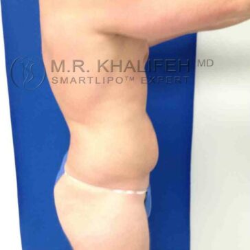 Side view of a person with visible abdominal fat, standing against a blue background, wearing blue underwear.