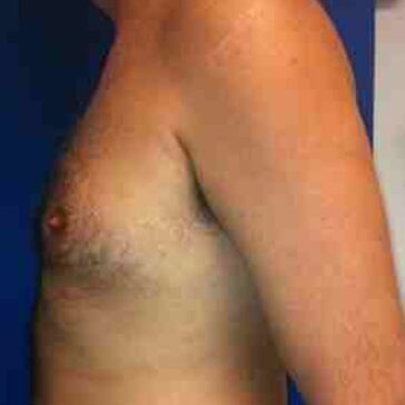 A shirtless adult male is shown from the side, displaying his chest, arm, and part of his torso against a blue and white background.