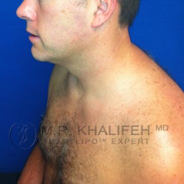 Man with light skin and short hair poses shirtless in front of a blue background, showing his side profile and upper torso. Text overlay reads "M.R. Khalifeh MD Smartlipo Expert.