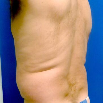 Side view of a shirtless person with visible uneven muscle structure and skin folds on the torso, standing against a blue background.