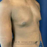 A shirtless person with mild gynecomastia stands against a blue background, showing an enlarged area around the left nipple.
