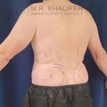 A person with marked lines on their lower back and sides, standing against a blue background, likely preparing for a cosmetic procedure.