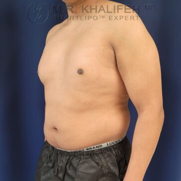A person with a bare upper body and visible abdominal fat stands against a blue background, wearing black shorts with a visible waistband.