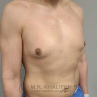 A person with a bare upper torso showing the chest and nipples, standing at an angle against a plain background. Watermark text at the bottom reads "M.R. Khalifeh MD Gynecomastia Specialist.