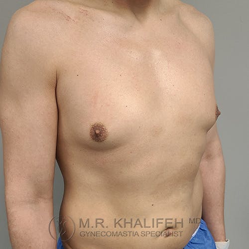 A person with a bare upper torso showing the chest and nipples, standing at an angle against a plain background. Watermark text at the bottom reads "M.R. Khalifeh MD Gynecomastia Specialist.