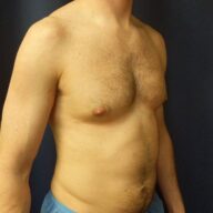 A shirtless man with a sunken chest stands against a dark background, facing slightly to the left.