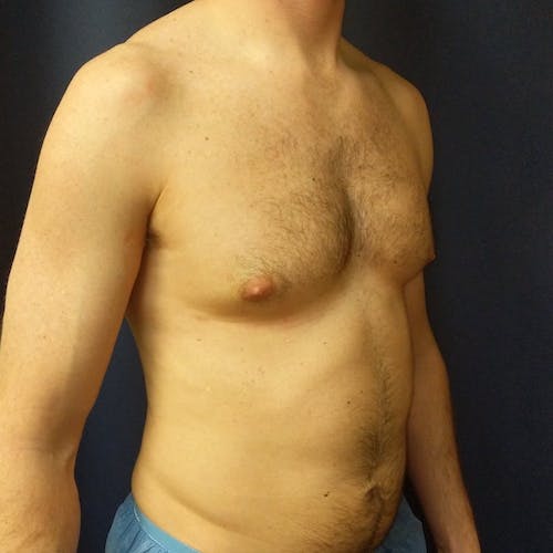 A shirtless man with a sunken chest stands against a dark background, facing slightly to the left.
