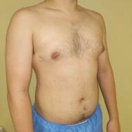 A shirtless person with a visible indentation in the chest stands against a beige wall, wearing blue shorts.