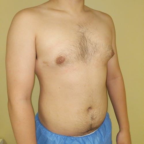 A shirtless person with a visible indentation in the chest stands against a beige wall, wearing blue shorts.