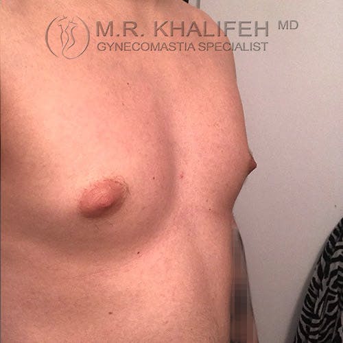 A close-up view of a person's chest with visible gynecomastia, with the text "M.R. Khalifeh MD Gynecomastia Specialist" in the upper corner.