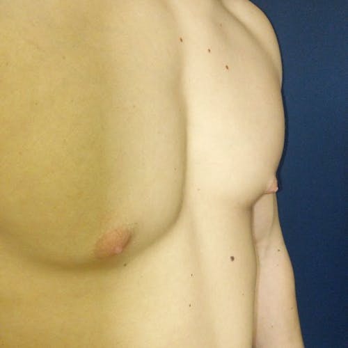 Shirtless torso of a person with noticeable asymmetry in the chest, possibly indicating a medical condition, against a blue background.