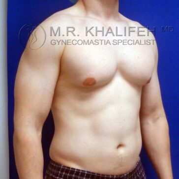 A shirtless man with visible gynecomastia on one side of his chest stands against a blue background.