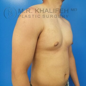 A shirtless man stands against a blue background, showing his upper body and chest in a side angle. "M.R. Khalifeh MD Plastic Surgery" is watermarked on the image.