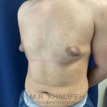 A shirtless man with visible gynecomastia stands in front of a blue background; his arms are behind his back.