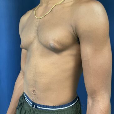 A shirtless person with a noticeably sunken area on the left side of their chest, standing against a blue background.