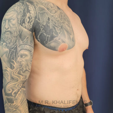 A shirtless man with an arm and shoulder tattoo is shown in profile, displaying a well-healed scar beneath his right nipple against a plain blue background.