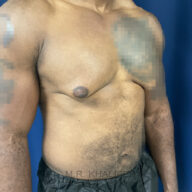 A shirtless man with a visible indentation and asymmetry on the left side of his chest, standing against a blue background.