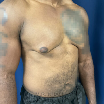 A shirtless man with a visible indentation and asymmetry on the left side of his chest, standing against a blue background.