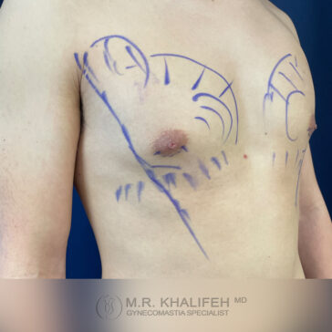 A person's bare chest with blue surgical markings, likely indicating planned gynecomastia or chest contouring surgery.