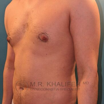 A shirtless adult male standing in front of a blue background, showing his upper body and torso. The watermark “M.R. Khalifeh MD Gynecomastia Specialist” is visible.