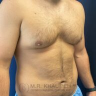 A shirtless male torso with visible chest and abdominal hair, standing sideways against a dark blue background. Watermark reads "M.R. Khalifeh MD Gynecomastia Specialist.