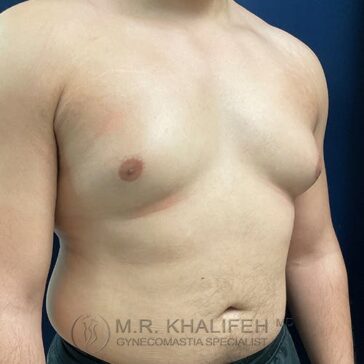 A shirtless person with visible gynecomastia on the right side of their chest stands against a dark blue background.