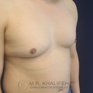 A person with excess breast tissue on the chest, indicative of gynecomastia, is shown from the side. The logo reads "M.R. Khalifeh MD, Gynecomastia Specialist.