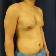 A shirtless person standing against a dark background, showing a visible indentation in the middle of the chest and a slight abdominal bulge.