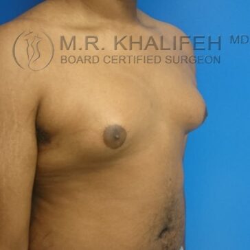 A male torso shown from the side against a blue background, displaying enlarged breast tissue consistent with gynecomastia.