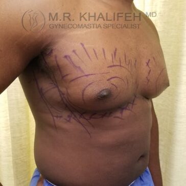 A person’s chest with surgical markings, indicating preoperative planning for gynecomastia surgery. Logo and name of gynecomastia specialist visible at top of image.