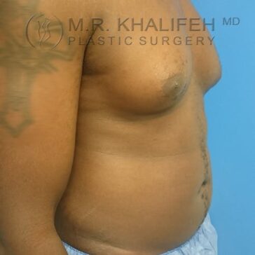 A person with visible chest and abdominal areas standing sideways against a blue background. The image is watermarked with "M.R. Khalifeh MD Plastic Surgery.