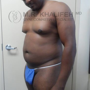 A man with gynecomastia stands in profile wearing blue disposable underwear in a medical exam room. Text reads "M.R. Khalifeh MD Gynecomastia Specialist.
