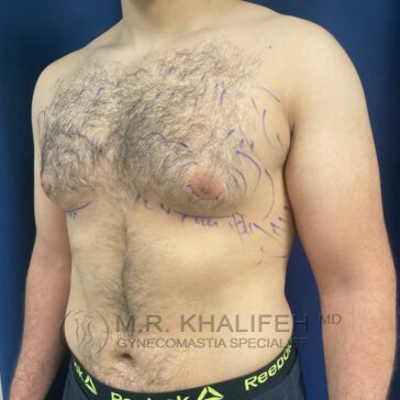 A shirtless person with gynecomastia and pre-surgical markings on their chest stands against a blue background. Text at the bottom reads "M.R. Khalifeh MD, Gynecomastia Specialist.