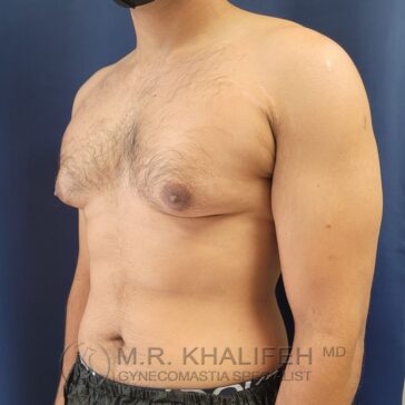 A shirtless man stands at an angle against a blue background, showing his chest and upper torso with visible gynecomastia.