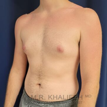 A shirtless person with visible redness and slight peeling on their shoulders and chest, indicating sunburn.